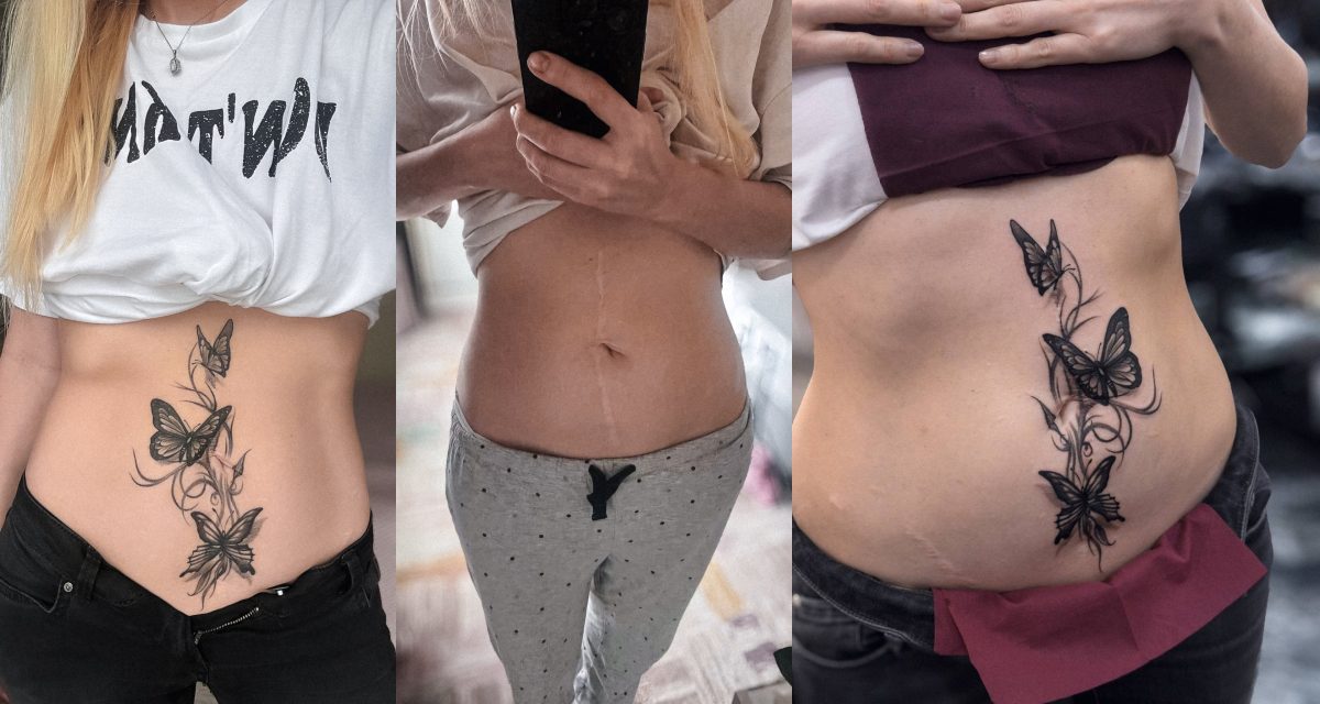 Tattooing Over Surgery Scars in Istanbul: Is It Possible and How Does It Work?